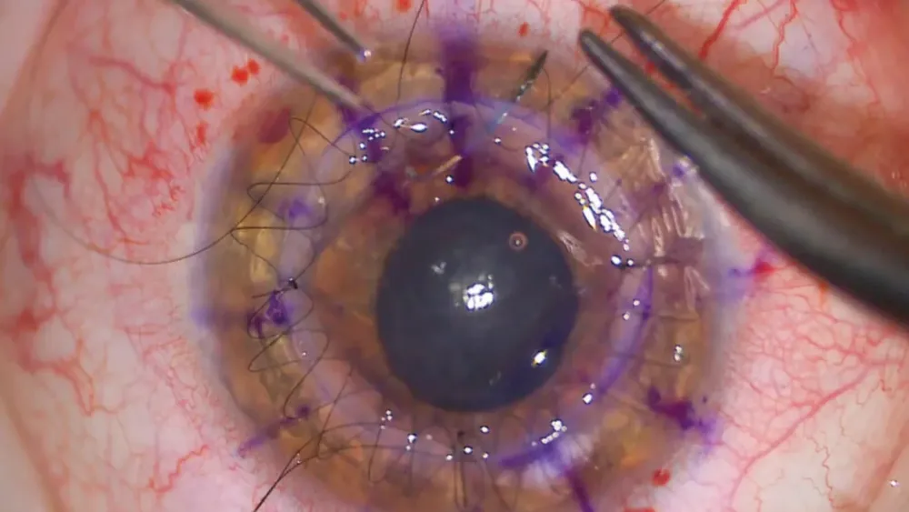 Trasplante de córnea.