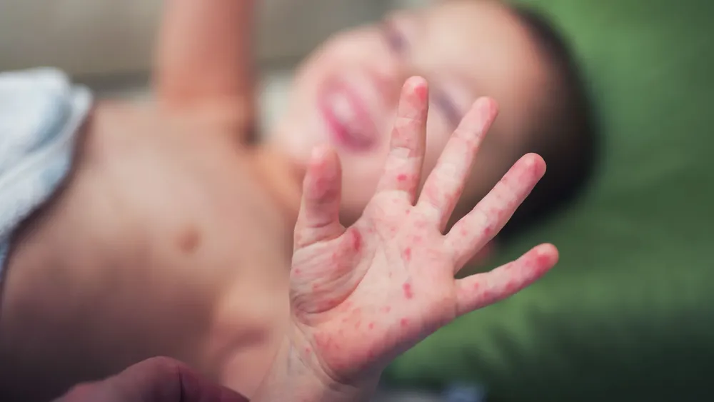 Sarampión en bebes.