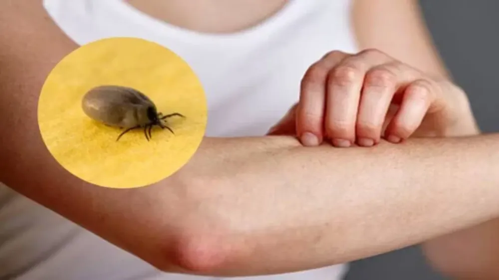 Babesiosis humana.