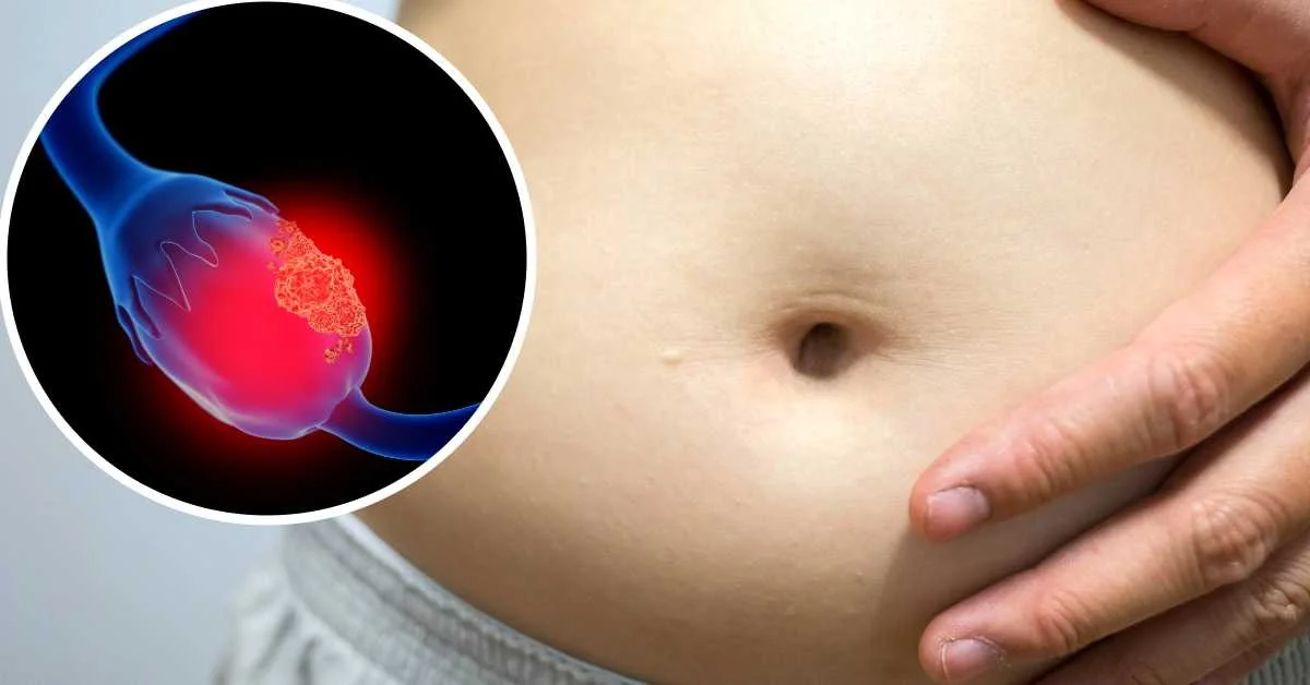 Cáncer de ovario.